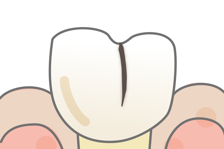 Cracked Tooth(歯牙の一部のひび)