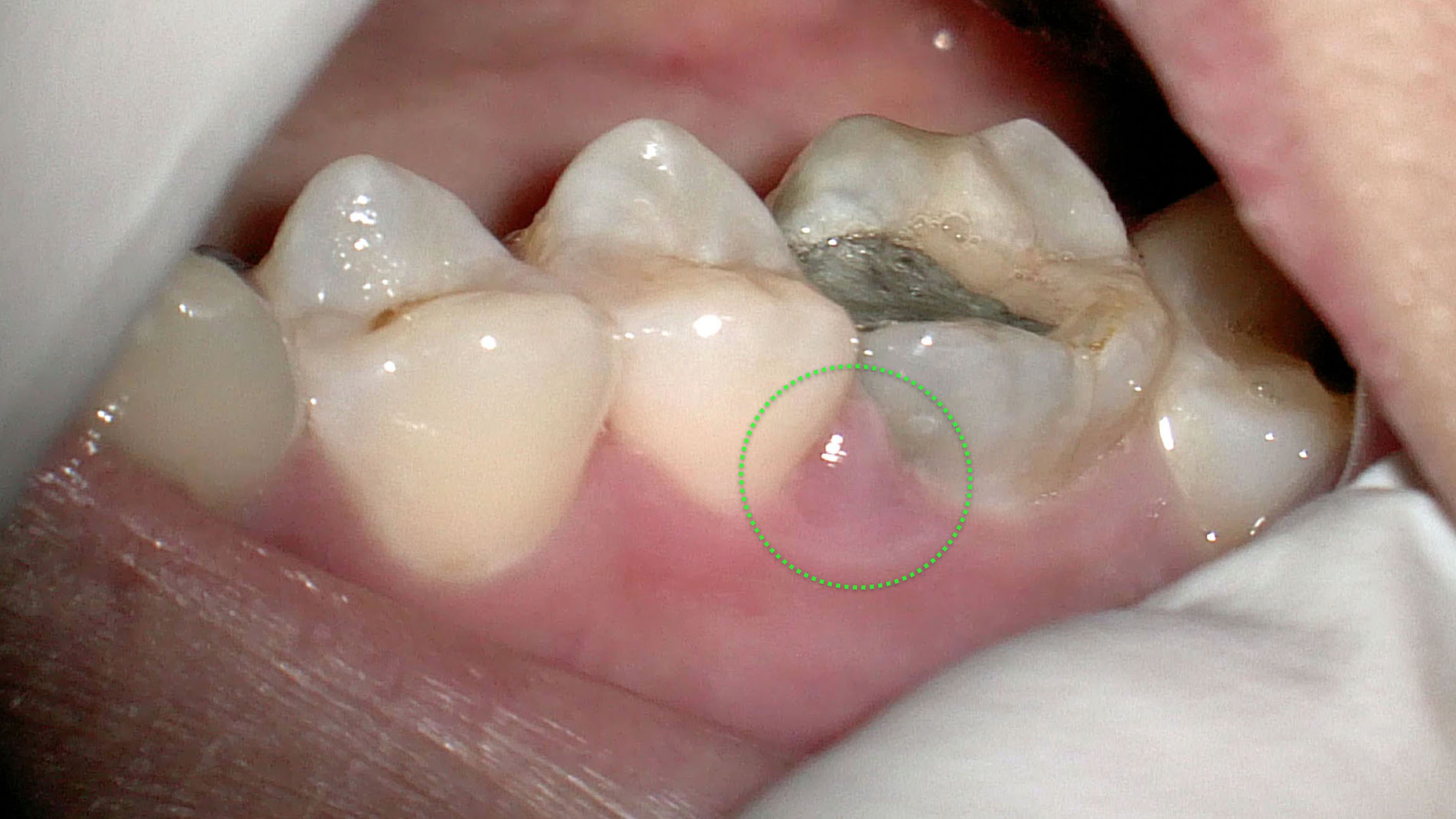 奥歯 の 歯茎 の 腫れ