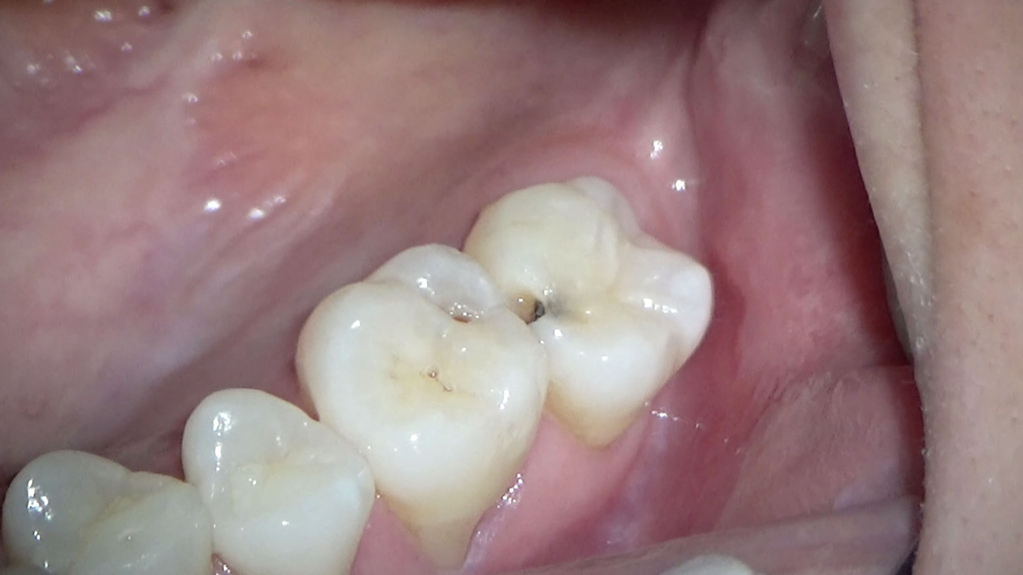 歯 欠け た 奥歯