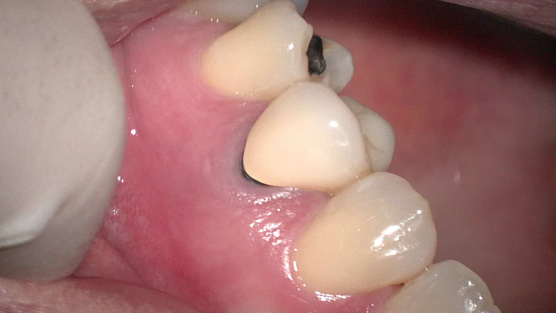 歯 の 打診 痛