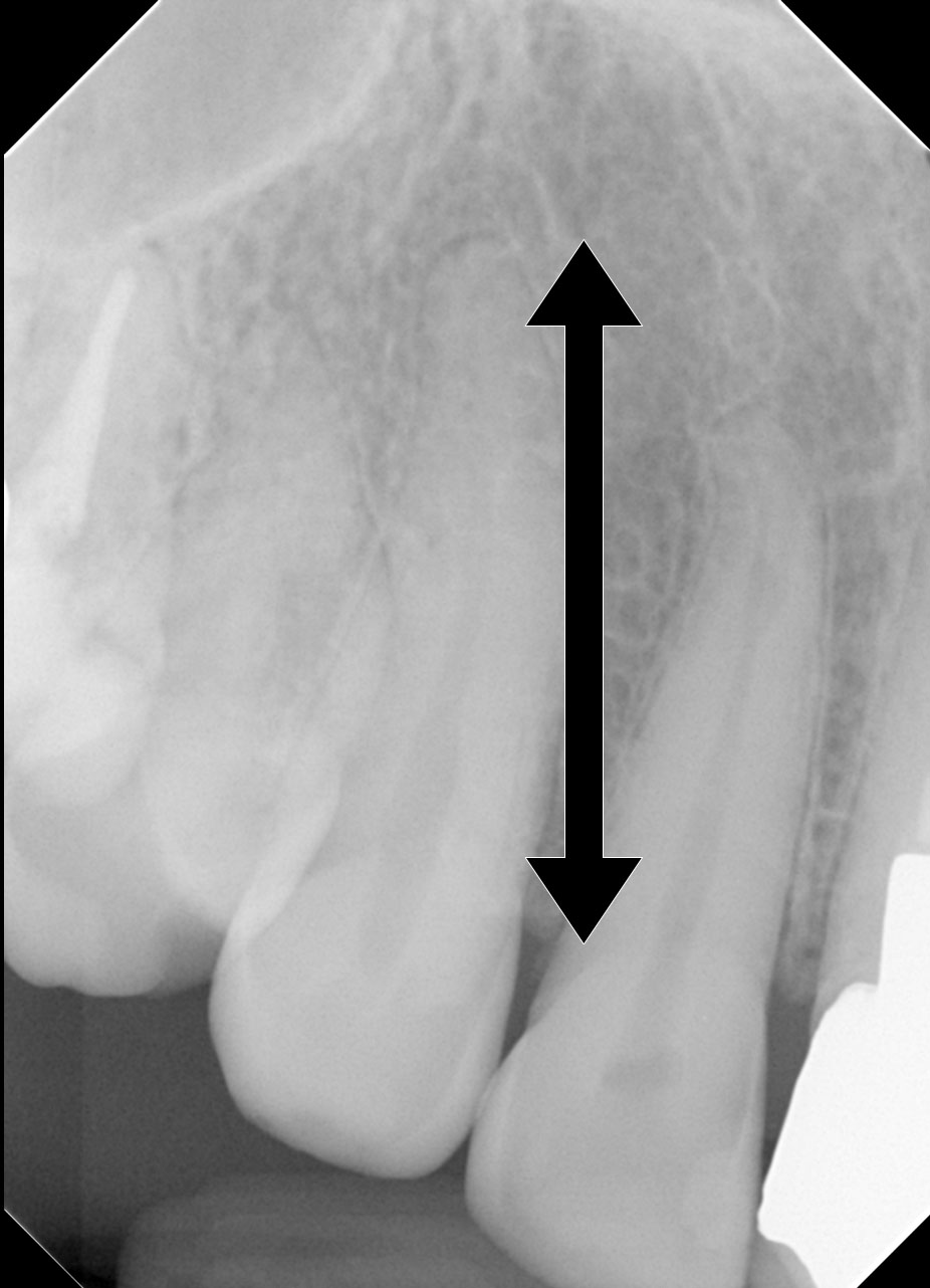 根管充填 垂直加圧充填法 の手順と適応歯について 医療法人社団徹心会ハートフル歯科