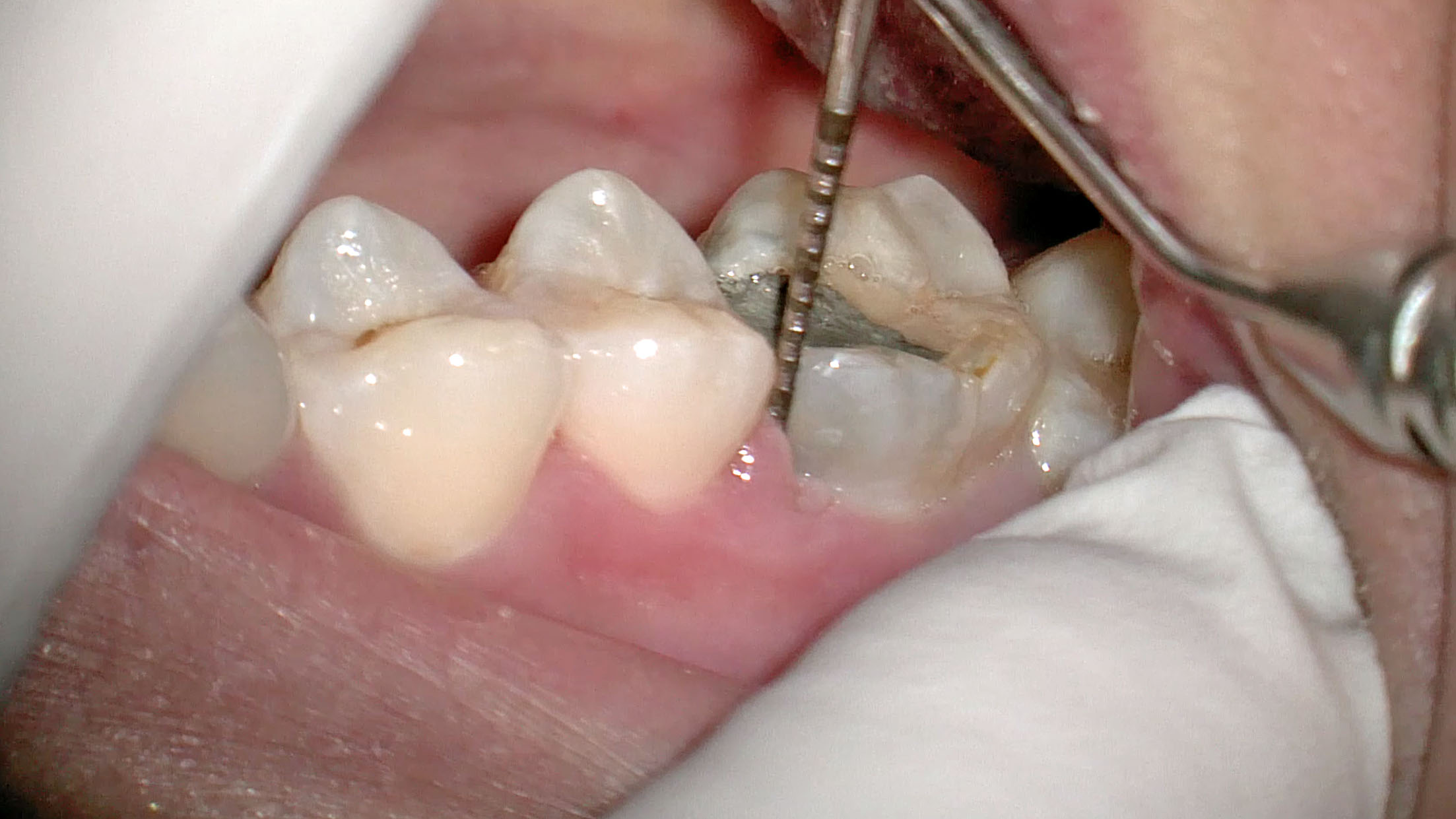 奥歯 の 腫れ