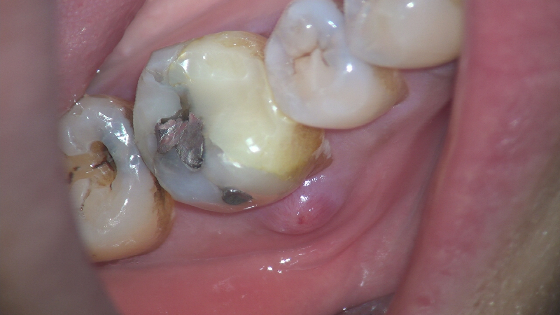 歯 の 根っこ 膿