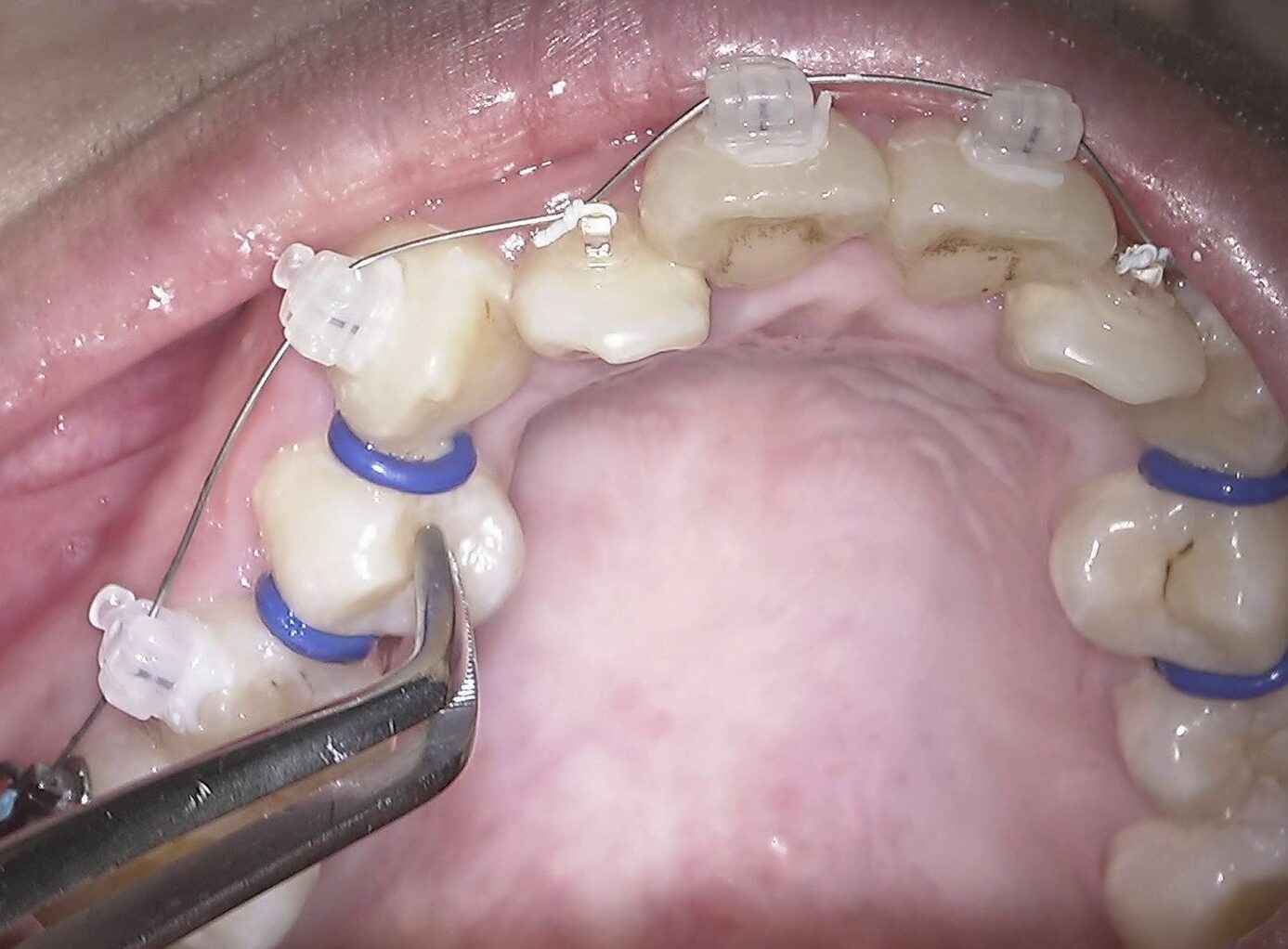 歯 を 抜き た が る 歯医者
