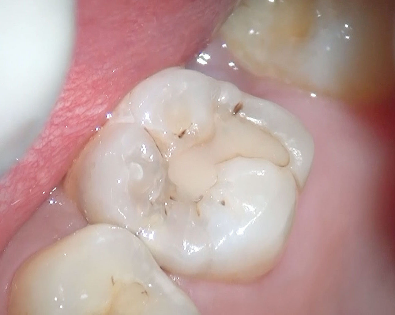 白い詰め物の下がむし歯になっていた 医療法人社団徹心会ハートフル歯科