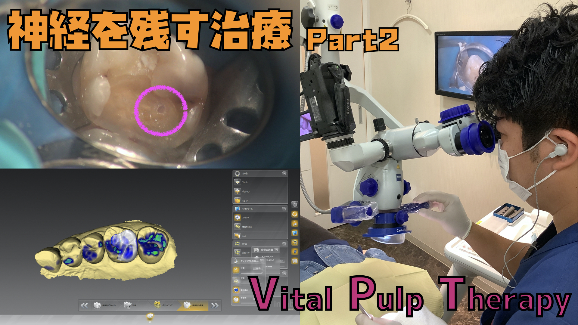 神経温存療法とは 〜神経を取らずに済む方法〜 Part2 - 医療法人社団徹