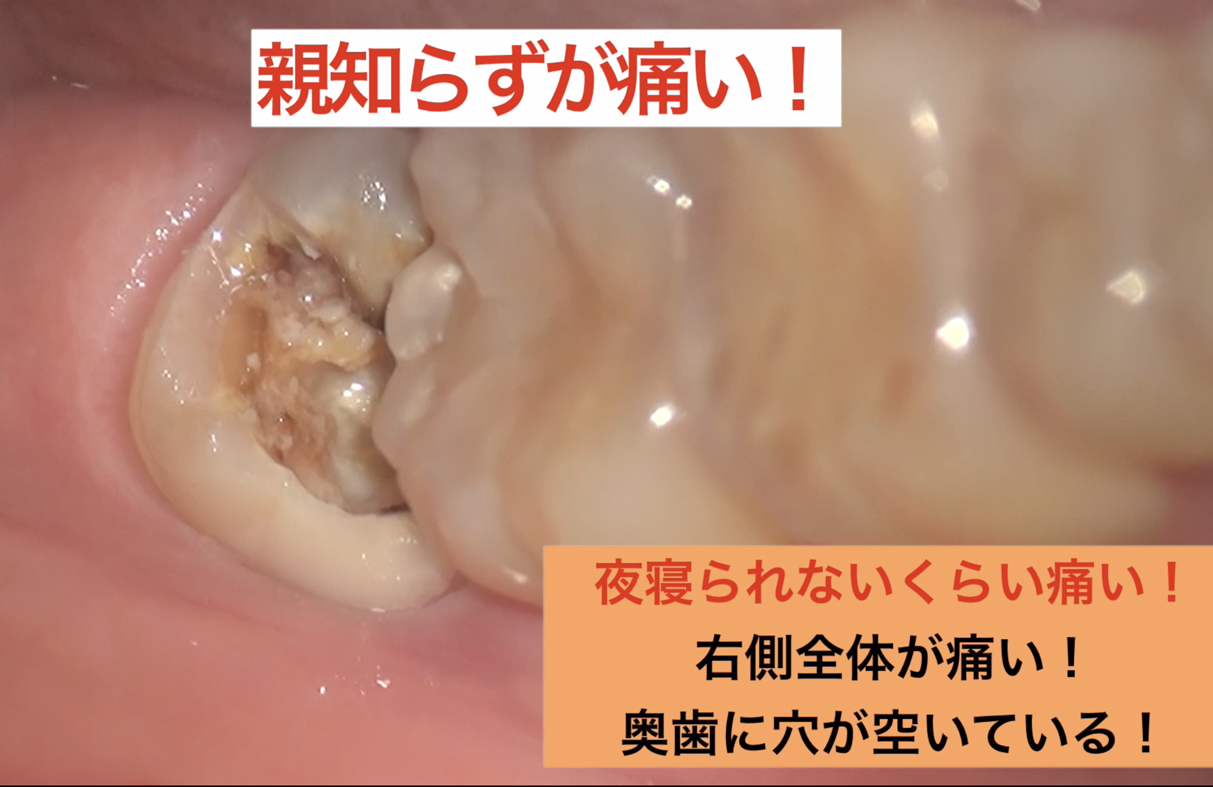 歯や歯茎の痛みのその他の原因