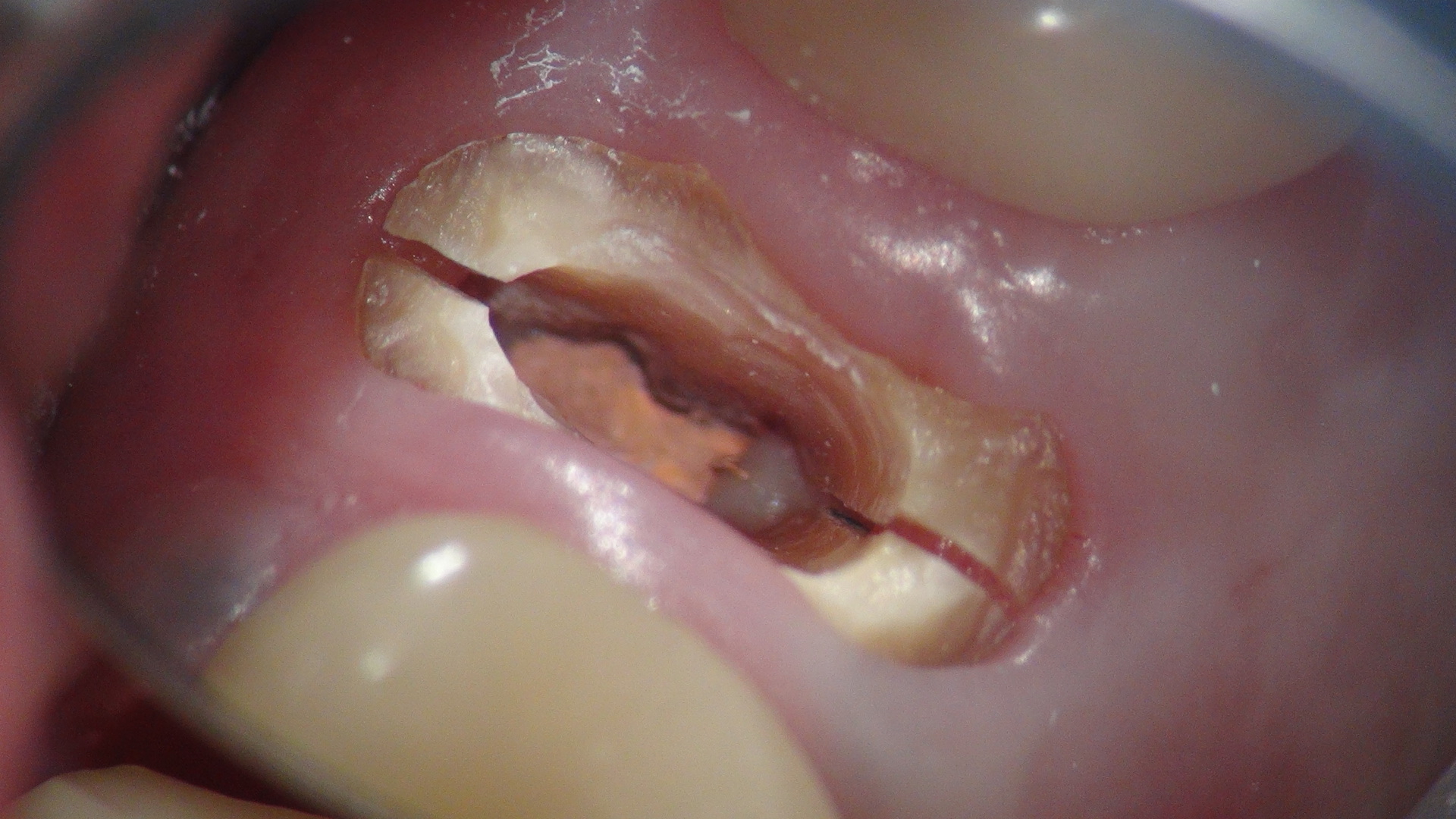 折 歯根 破 歯根破折放置で膿と臭い痛み！歯の根っこが割れたら保存か抜歯