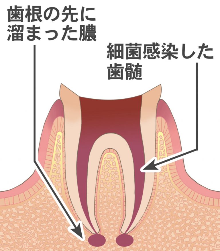 感染根管治療が必要になる症状について 医療法人社団徹心会ハートフル歯科 感染根管治療が必要になる症状について 医療法人社団徹心会ハートフル歯科