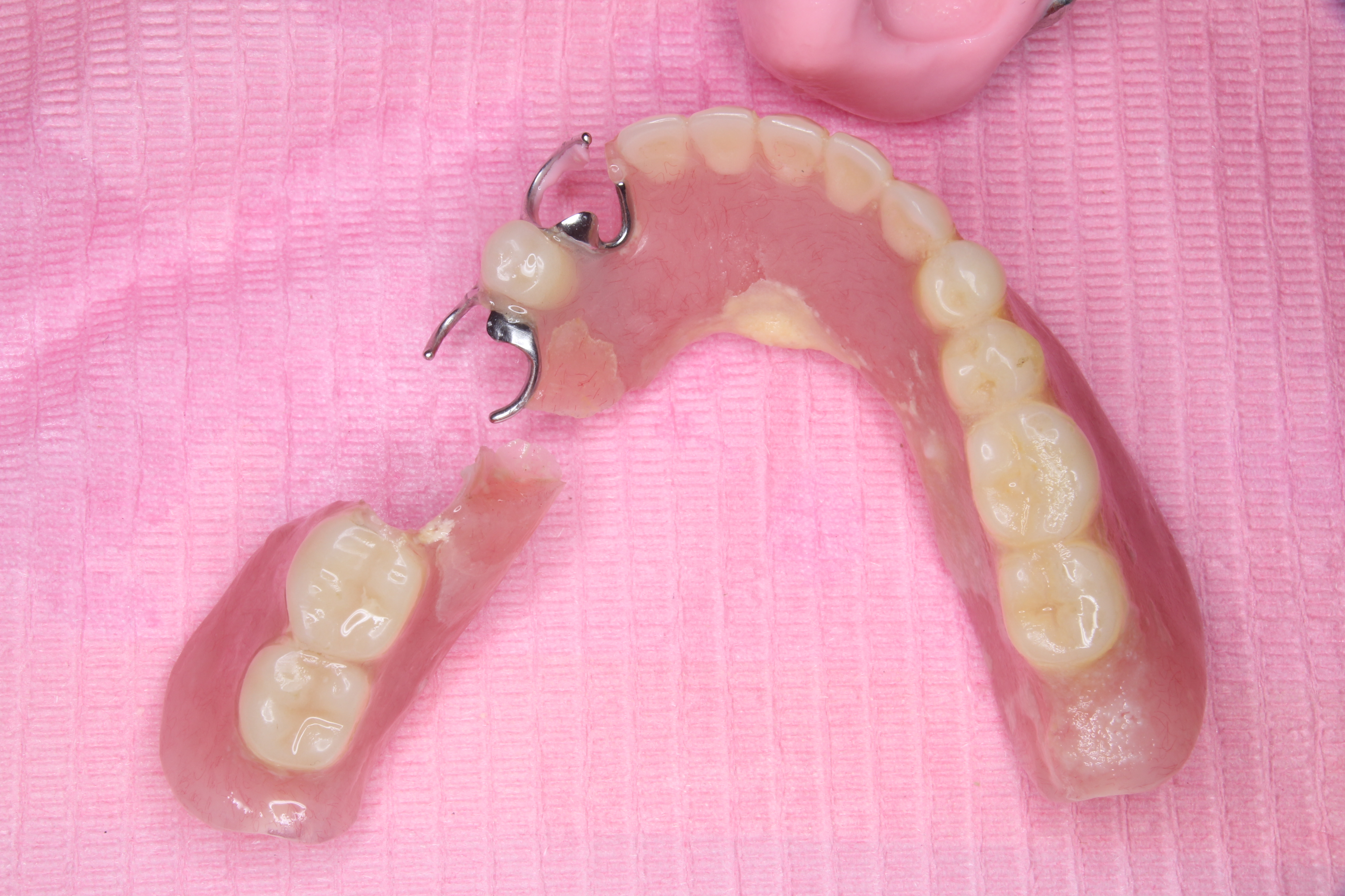 入れ歯 割れ た 修理