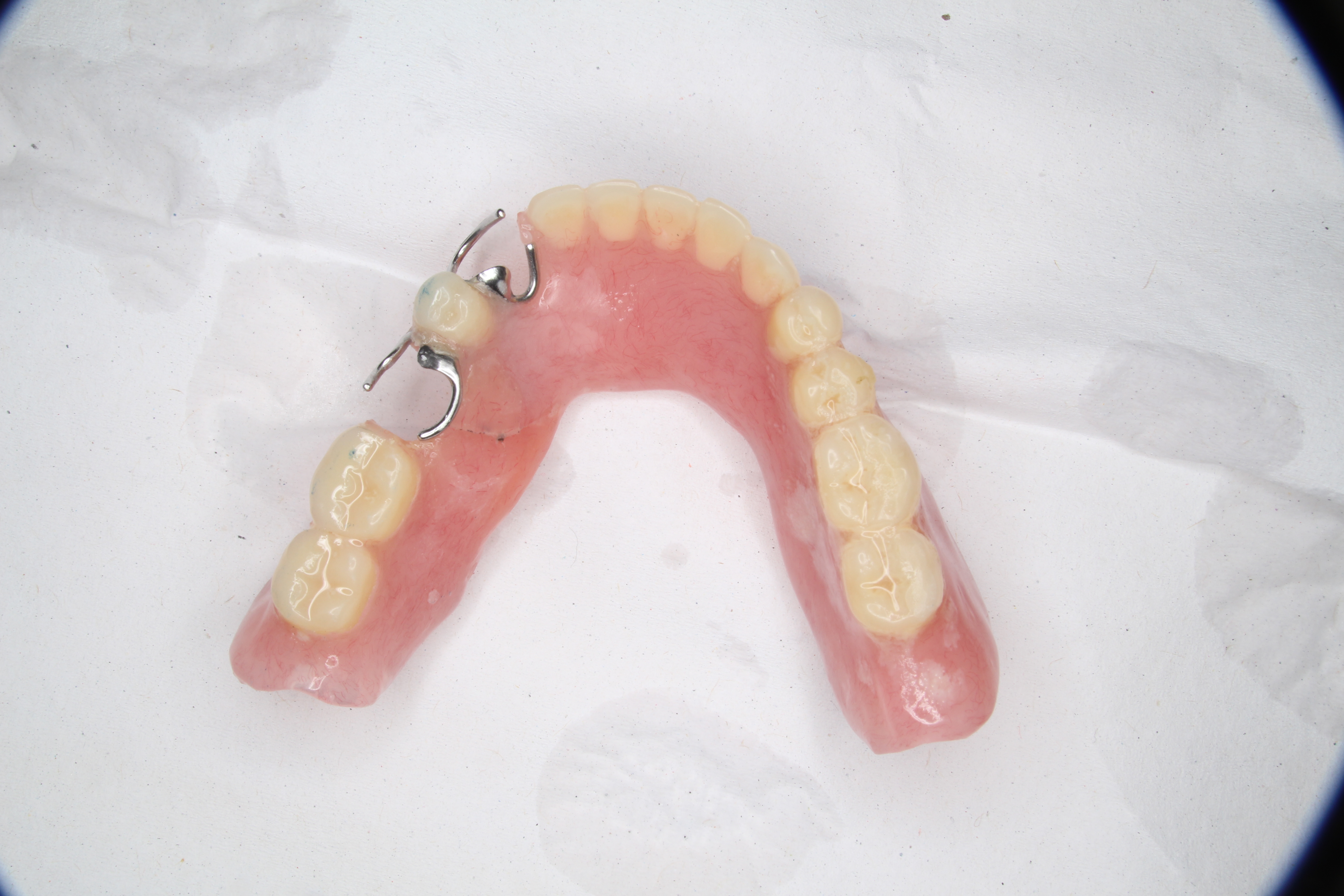 入れ歯 が 割れ た 応急 処置