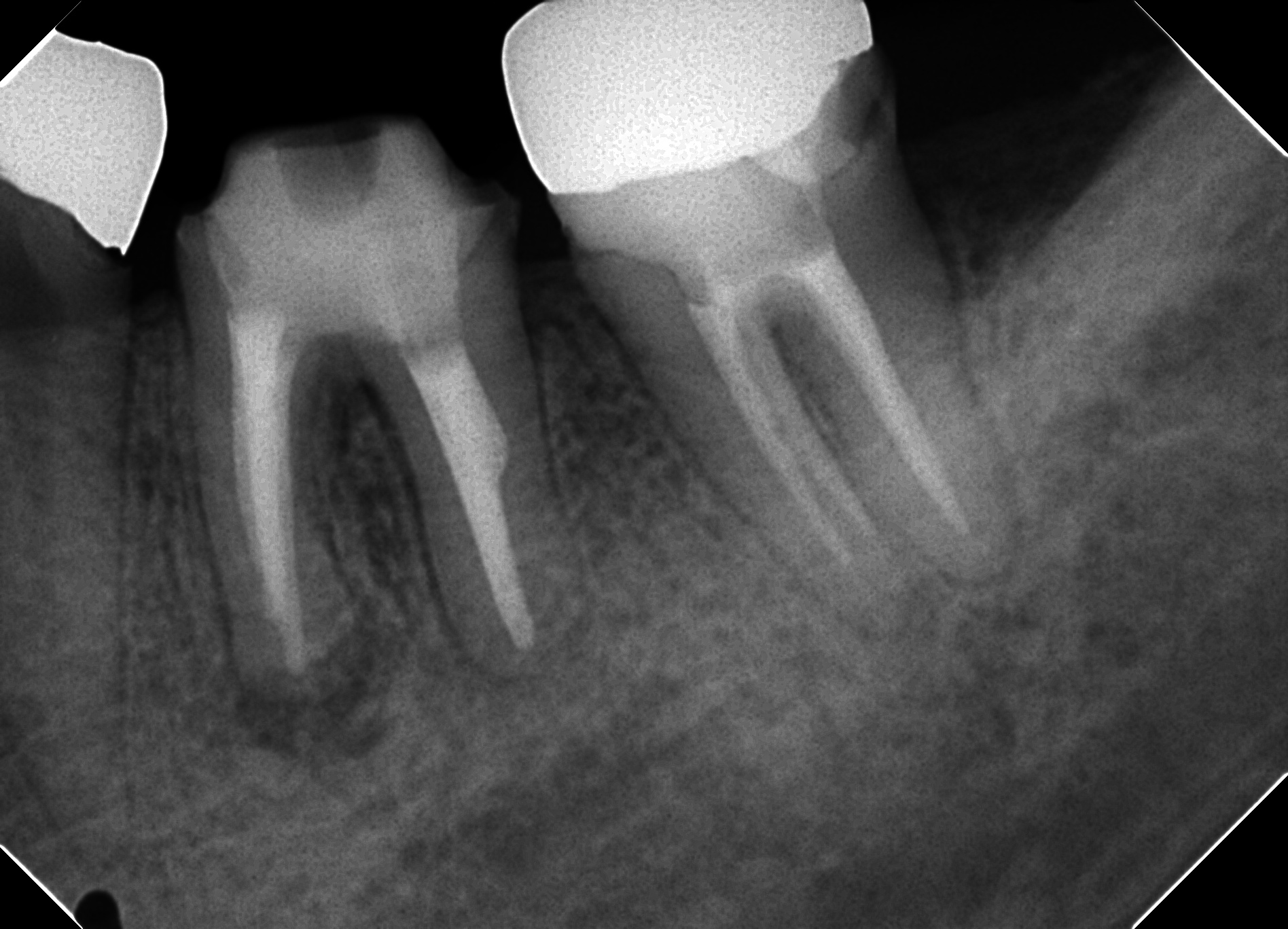 歯を救うために 38 左下7番抜髄治療 根管治療の予後 医療法人社団徹心会ハートフル歯科