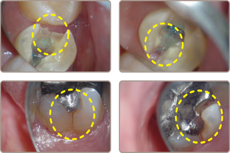 破折歯の治療について