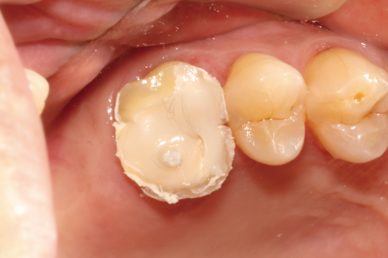 歯根のひびに負担をかけない土台を建て、更なる破折を予防する。